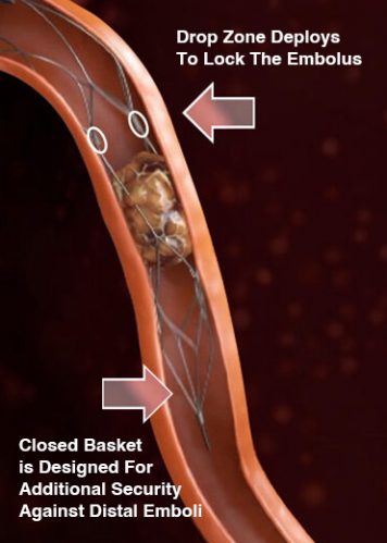 pvasc_diagram_images-final1.jpg